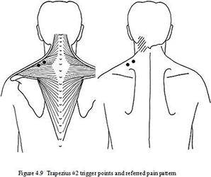 Pinpointing the Pain with Trigger Point Therapy - Mpls.St.Paul